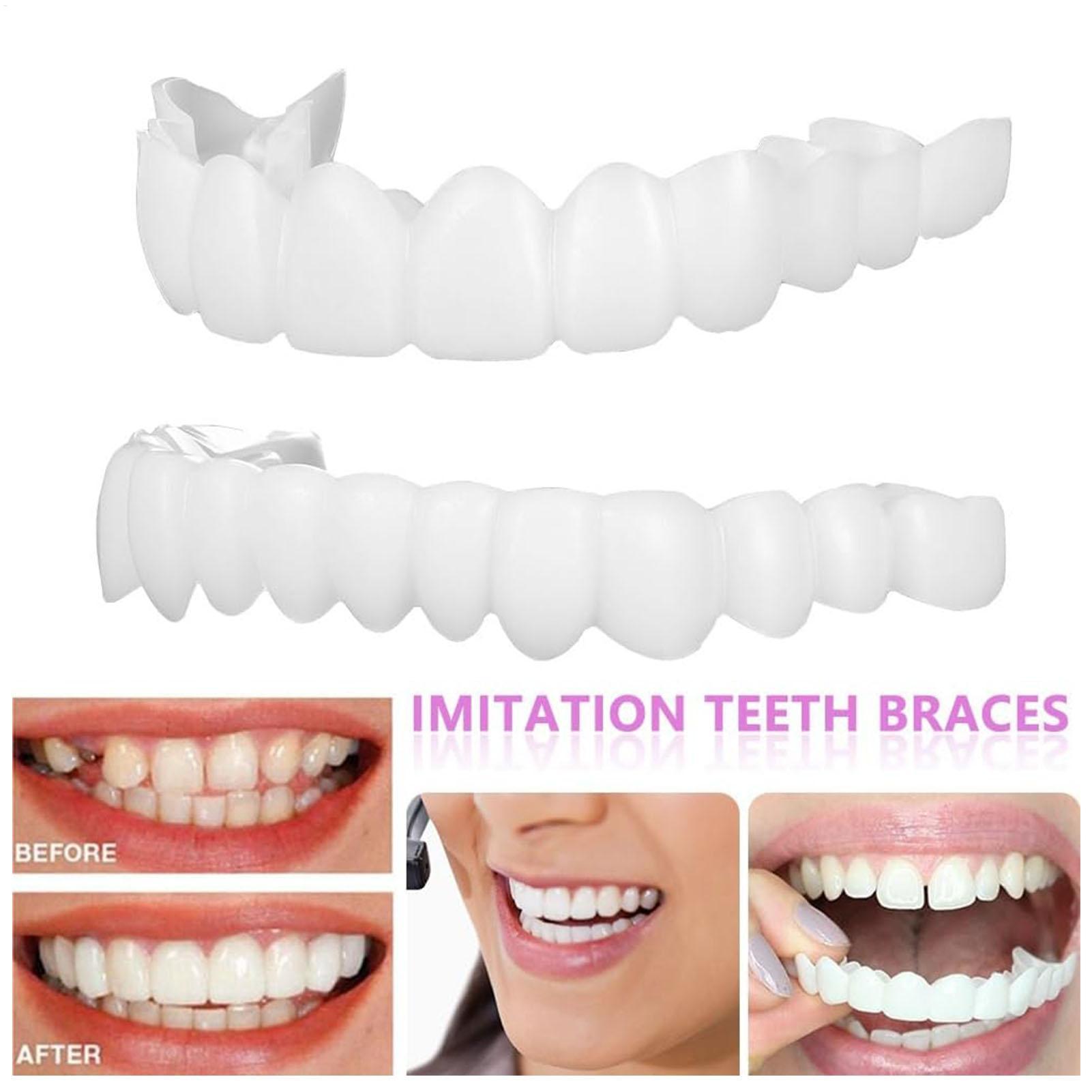 ฟันปลอมครอบฟันบนล่าง วีเนียร์ส - Teeth Whitening With Braces บทวิจารณ์และราคา