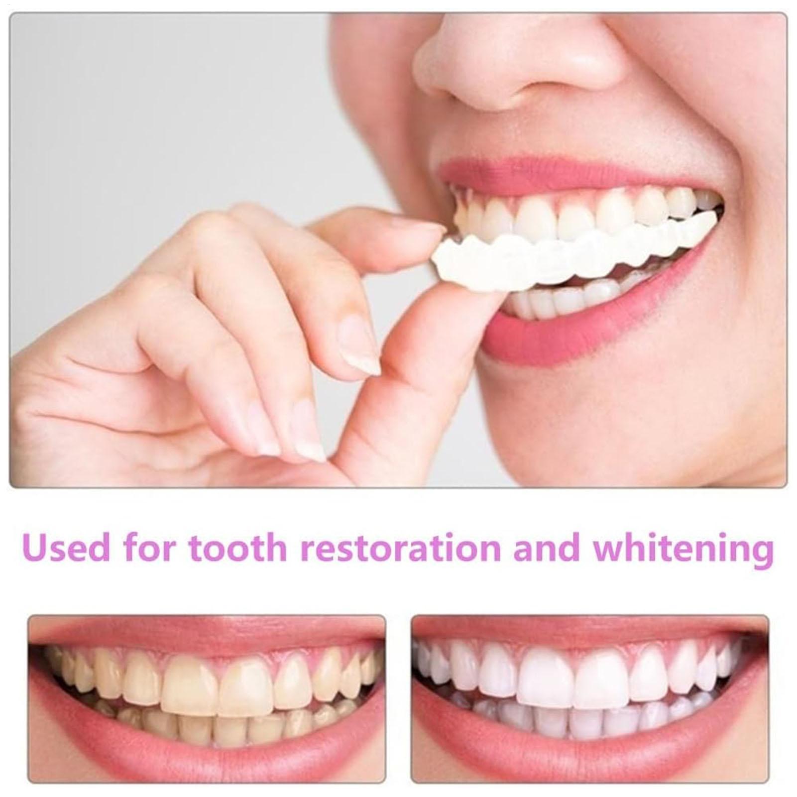 ฟันปลอมครอบฟันบนล่าง วีเนียร์ส - Teeth Whitening With Braces บทวิจารณ์และราคา