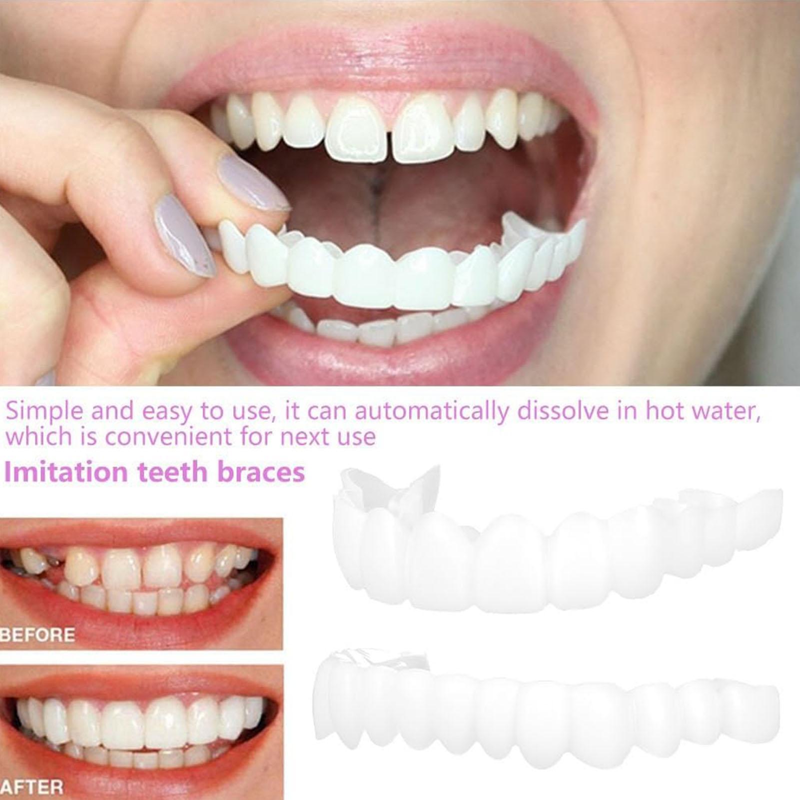 ฟันปลอมครอบฟันบนล่าง วีเนียร์ส - Teeth Whitening With Braces บทวิจารณ์และราคา