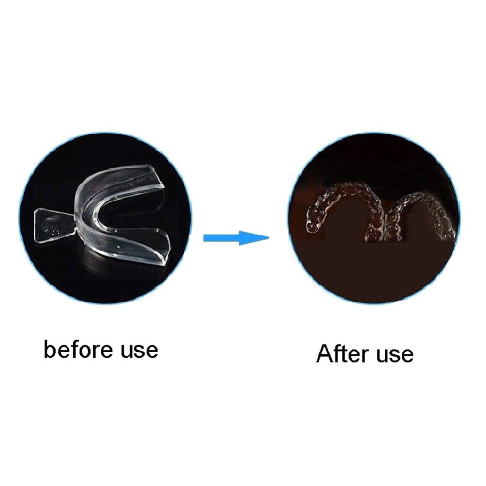 ชุดอุปกรณ์จัดฟันแบบนุ่ม 2/4 ชิ - Teeth Whitening With Braces บทวิจารณ์และราคา