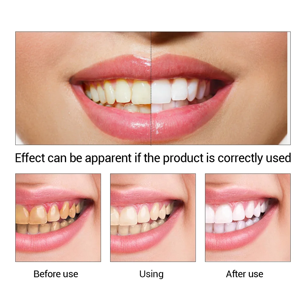 FTEENPLY ฟันไวท์เทนนิ่ง Oral ส - Teeth Whitening Treatment บทวิจารณ์และราคา