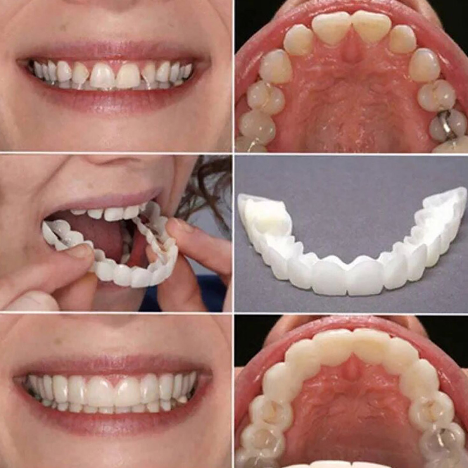 วีเนียร์ฟันแบบชั่วคราว ฟันปลอม - Teeth Whitening With Braces บทวิจารณ์และราคา