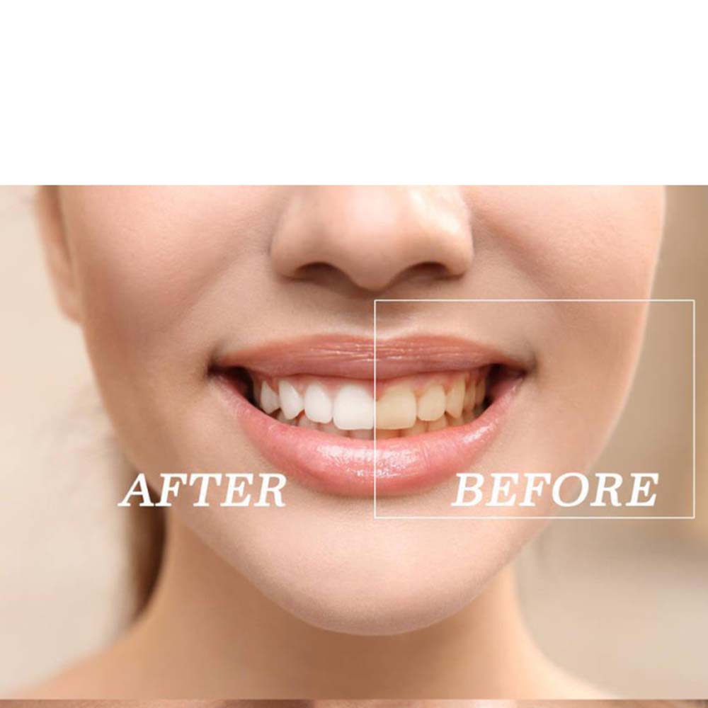 ชุดเจลฟอกสีฟอกสีฟันเปอร์ออกไซด - Teeth Whitening Gels บทวิจารณ์และราคา
