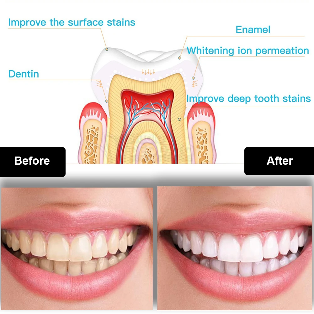 ทันตกรรมชุดฟอกสีฟัน Mini 16 LE - Teeth Whitening With Hydrogen Peroxide บทวิจารณ์และราคา